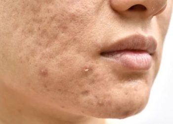 Cara Alami dan Prosedur Medis Mengatasi Bopeng Bekas Jerawat