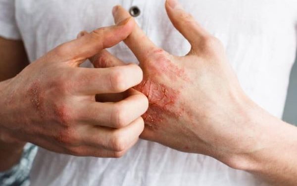 Penyakit Autoimun dan Gangguan Sistem Kekebalan yang Perlu Diwaspadai
